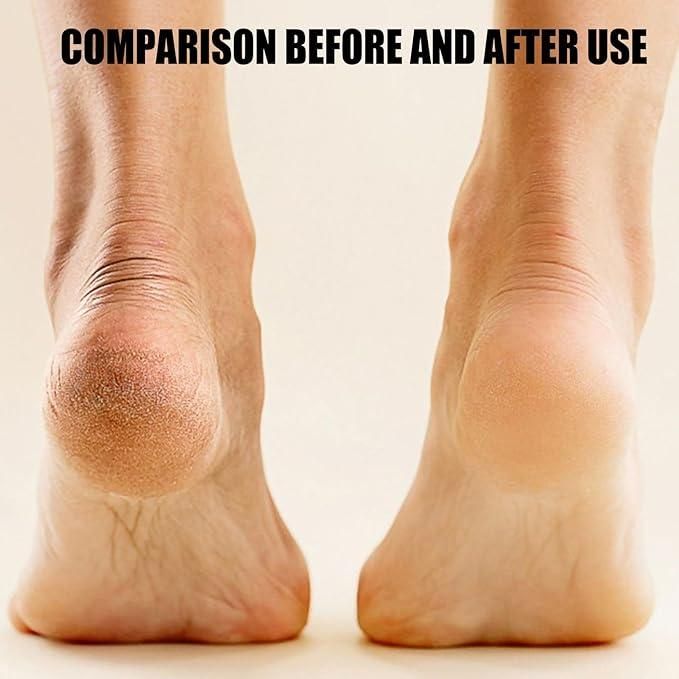 Electronic Callus Remover - Pedicure Tool✨